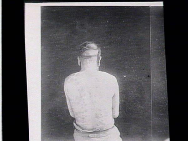 the back of a man with leprosy